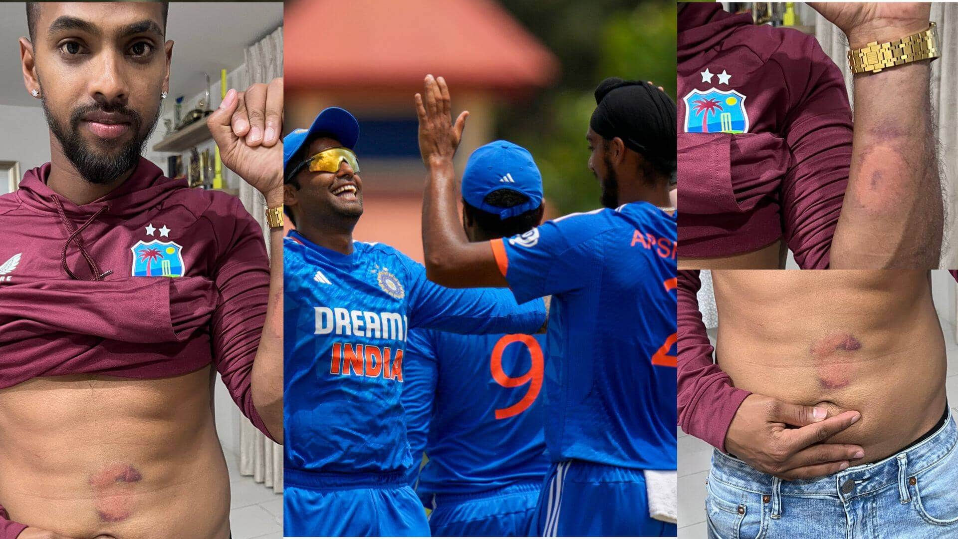 Nicholas Pooran Shows Off Inflicted Bruises After Guiding West Indies To T20I Series Win Over India